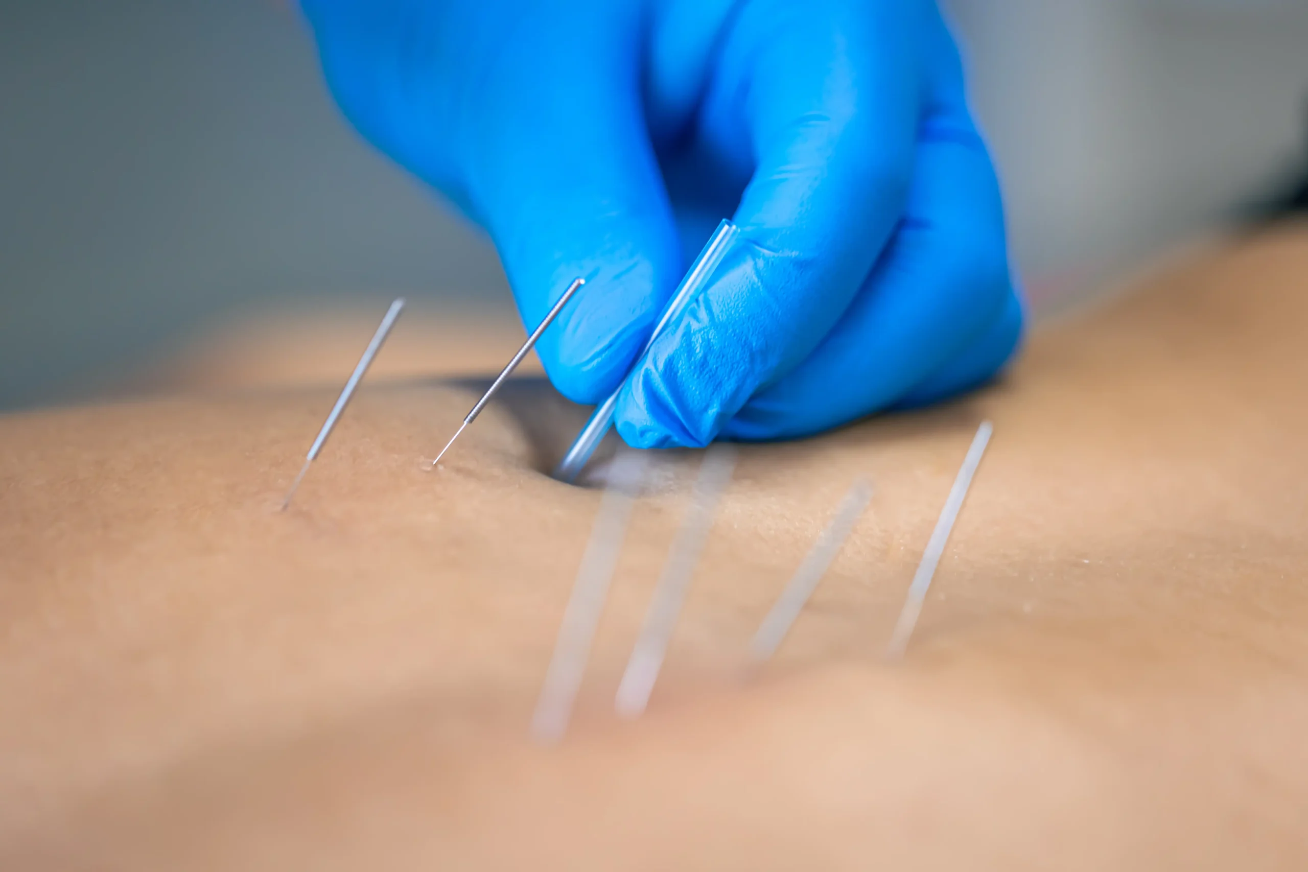 Family Practice of Chiropractic placing dry needles into a patient.